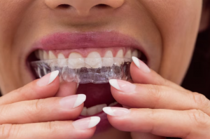 What Makes the Invisalign Treatment an Ideal Choice?